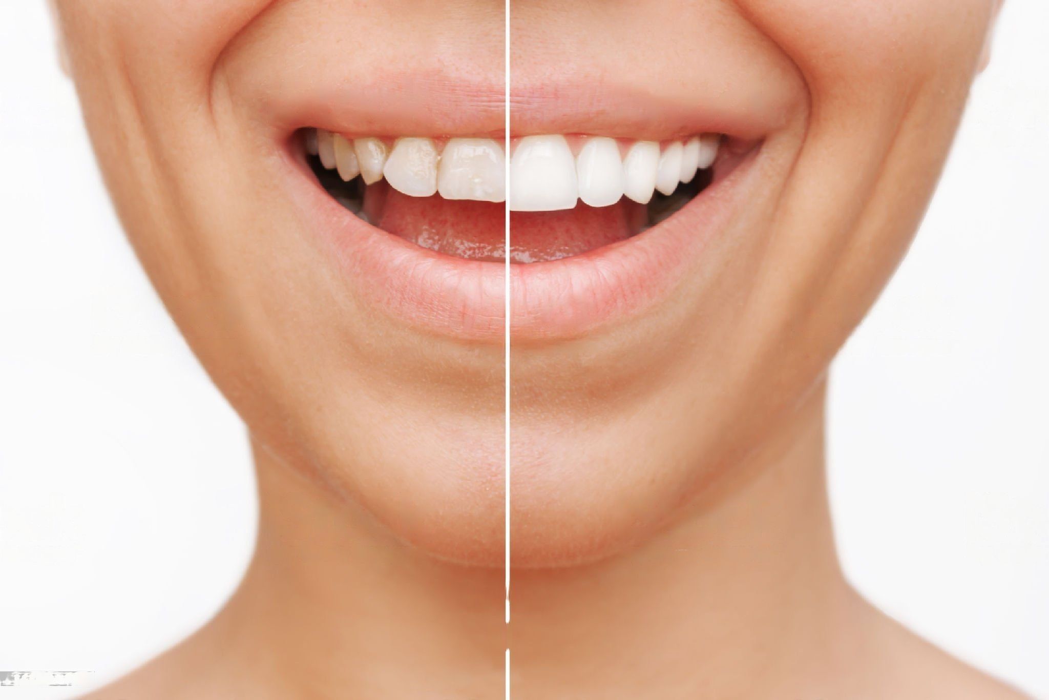 Boost Your Smile with Dental Veneers